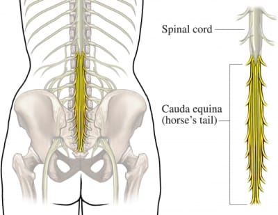 Lesão do cone medular e cauda equina e a ejaculação masculina